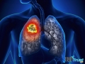 Dấu hiệu nhận biết ung thư phổi giai đoạn đầu