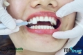Địa chỉ bọc răng sứ uy tín nhất Nha Trang