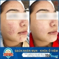 địa chỉ điều trị mụn, điều trị sẹo rỗ tốt nhất tại Pleiku, Gia Lai