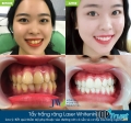 Địa chỉ tẩy trắng răng uy tín chất lượng ở Đà Nẵng
