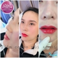 Địa chỉ tiêm filler - botox uy tín và chất lượng nhất Đà Nẵng