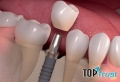 địa chỉ trồng  răng implant uy tín nhất quận Long Biên, Hà Nội