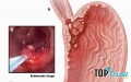 điều cần biết nhất về căn bệnh ung thư dạ dày