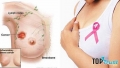 điều cần biết nhất về căn bệnh ung thư vú