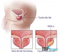điều cần biết nhất về ung thư tuyến tiền liệt