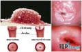 điều cần biết về ung thư cổ tử cung