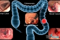 điều cần biết về Ung thư đại tràng