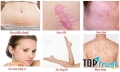 Sản phẩm đặc trị sẹo tốt nhất hiện nay