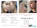 Spa trị mụn hiệu quả nhất ở Nha Trang