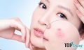 Spa trị mụn hiệu quả nhất thành phố Vinh, Nghệ An