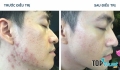 Spa trị sẹo rỗ do mụn tốt nhất Quảng Ngãi