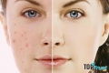 Thẩm mỹ viện trị mụn uy tín nhất ở TPHCM