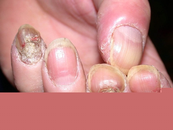 Thuốc đặc trị nấm móng tay chân hiệu quả nhất được tin dùng