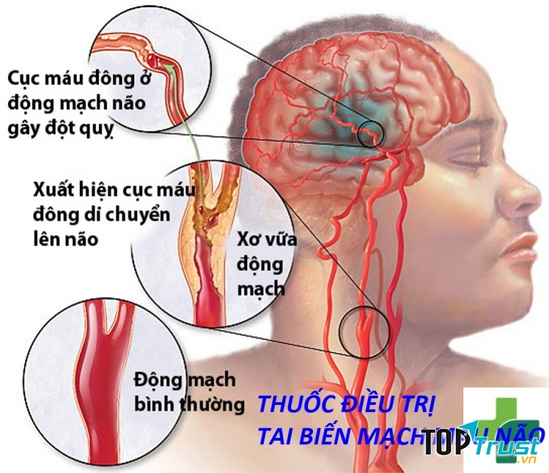 Thuốc điều trị tai biến mạch máu não hiệu quả nhất