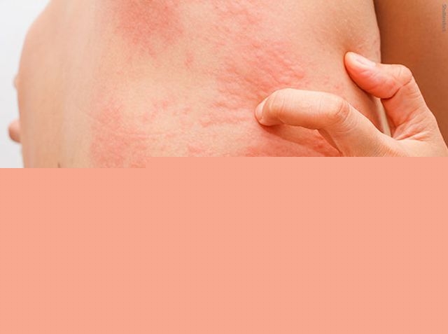 Thuốc hỗ trợ điều trị mề đay, mẩn ngứa hiệu quả nhất hiện nay