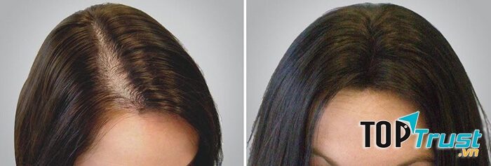 Thuốc mọc tóc Nhật Bản tốt nhất hiện nay